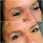 microblading