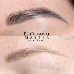 phiremoval